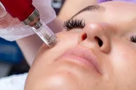 mocro needling