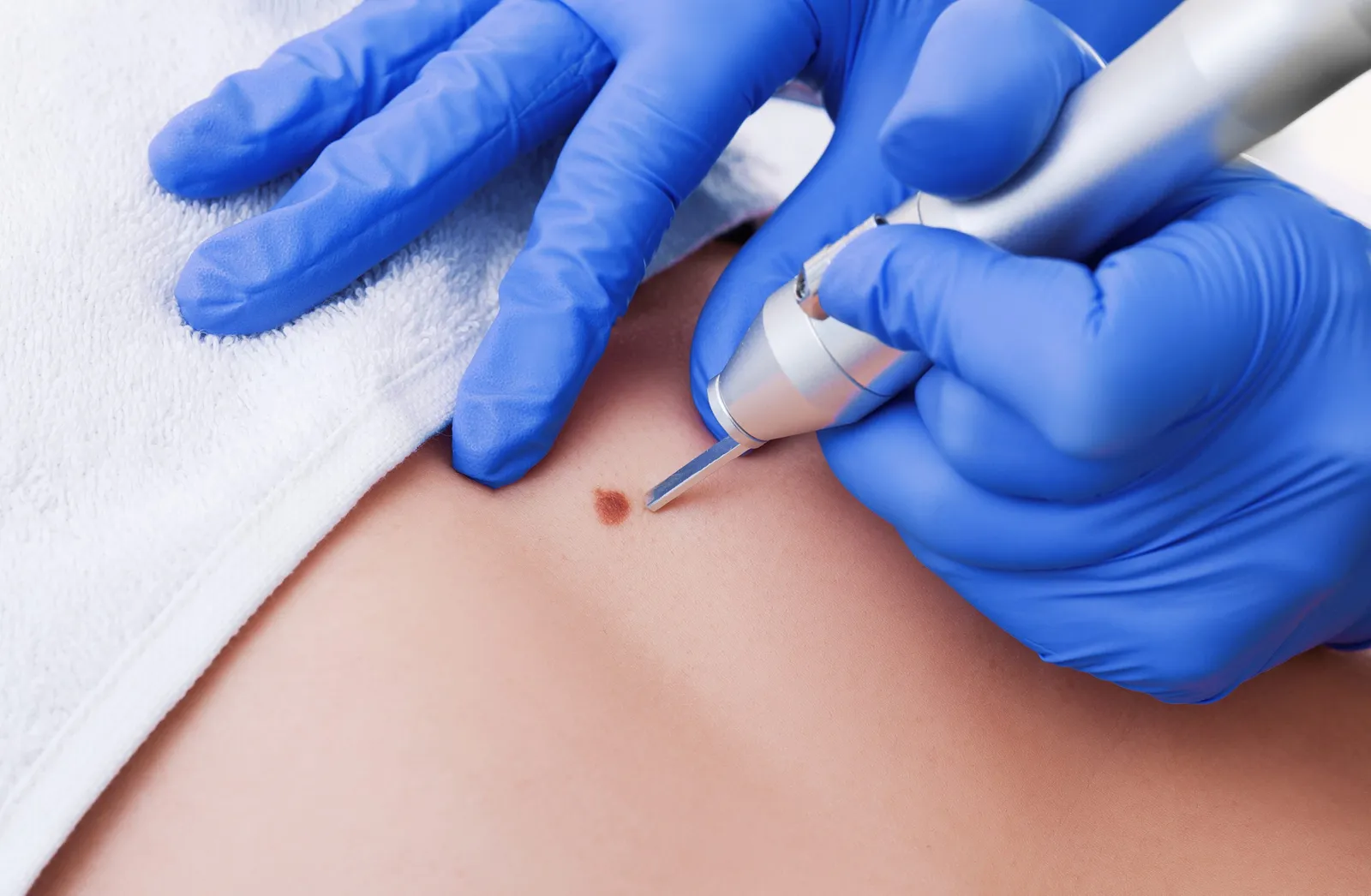 Removal,Of,Benign,Tumors,In,Cosmetic,Salon.,The,Use,Of